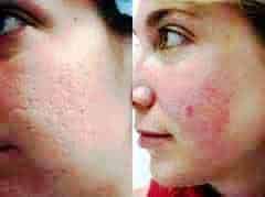 Pelle con acne prima e dopo trattamento, miglioramento visibile, cura della pelle, cosmetici, bellezza viso, skincare, trattamento acne, risultati, glow naturale.