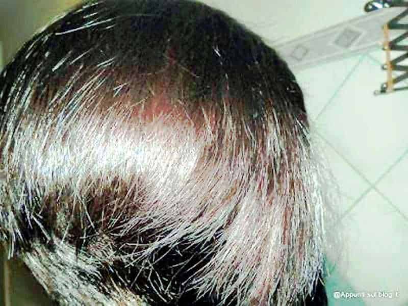 trattamenti e cure naturali per la perdita di capelli 