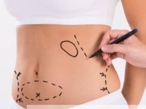Rischi della liposuzione: complicazioni, effetti collaterali e cosa sapere