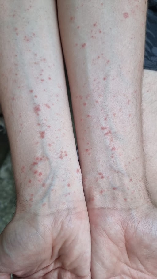 infezioni cutanee sulle braccia 