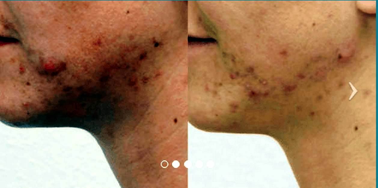 PMD personal microderm per pelle viso senza difetti