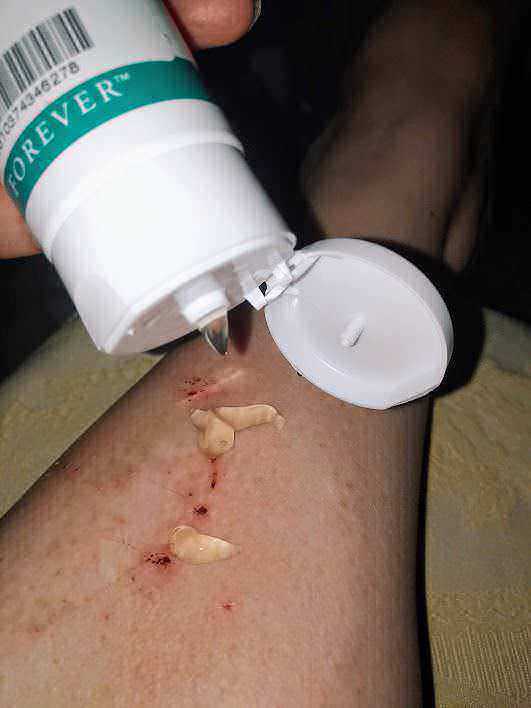 Crema farmaceutica per il trattamento di ferite e infezioni cutanee, applicata sulla pelle lesa.