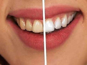 Sorriso con denti sani e bianchi, prima e dopo trattamento di sbiancamento dentale, sorriso luminoso e cura dentale professionale.