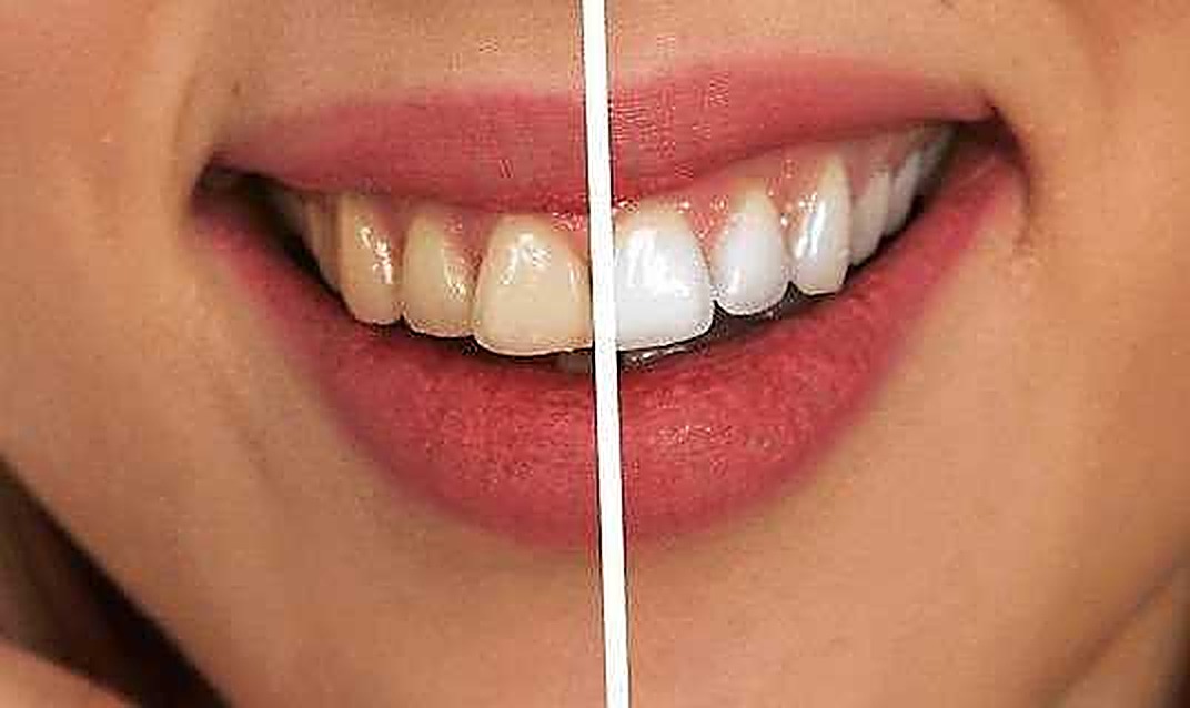 Sorriso con denti sani e bianchi, prima e dopo trattamento di sbiancamento dentale, sorriso luminoso e cura dentale professionale.