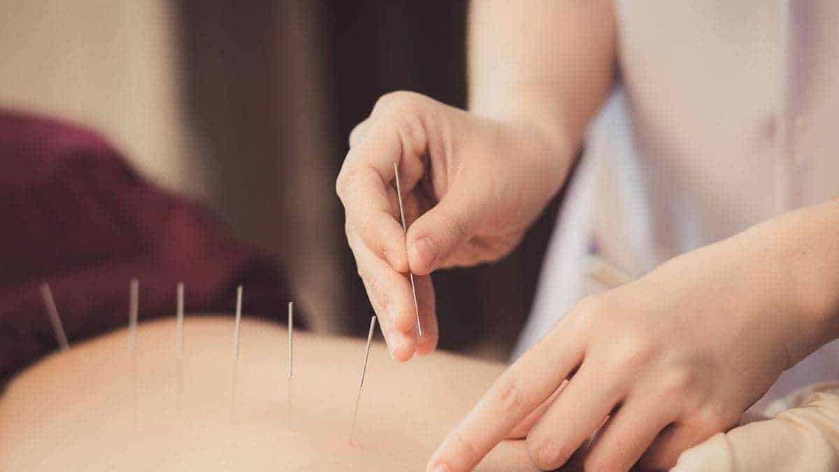 Agopuntura sul addome in trattamento terapeutico, immagini di medicina alternativa e benessere naturale. Terapia con aghi per alleviare dolore e stress, approccio olistico alla salute.