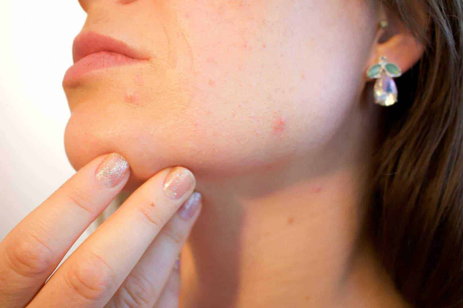 Pelle con acne e punti neri sul viso di una donna, primo piano, cura della pelle, problemi cutanei.