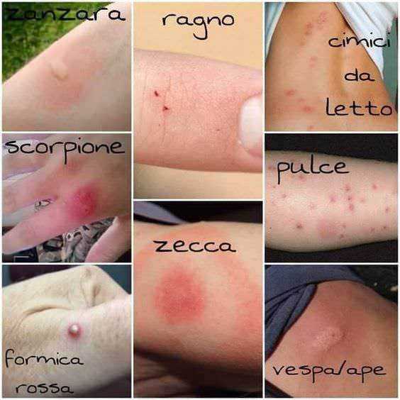Diagnosi di punture di insetti su diverse parti del corpo, con foto e nomi delle lesioni come zanzara, ragno, cimici da letto, scorpione, zecca, pulce, Farmacia Rossa e vespa/papa.