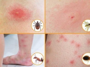 Puntura di zecca, puntura di zanzara, punture di insetti, reazioni allergiche da punture, punture di insetti su pelle umana, punture di insetti e reazioni cutanee.