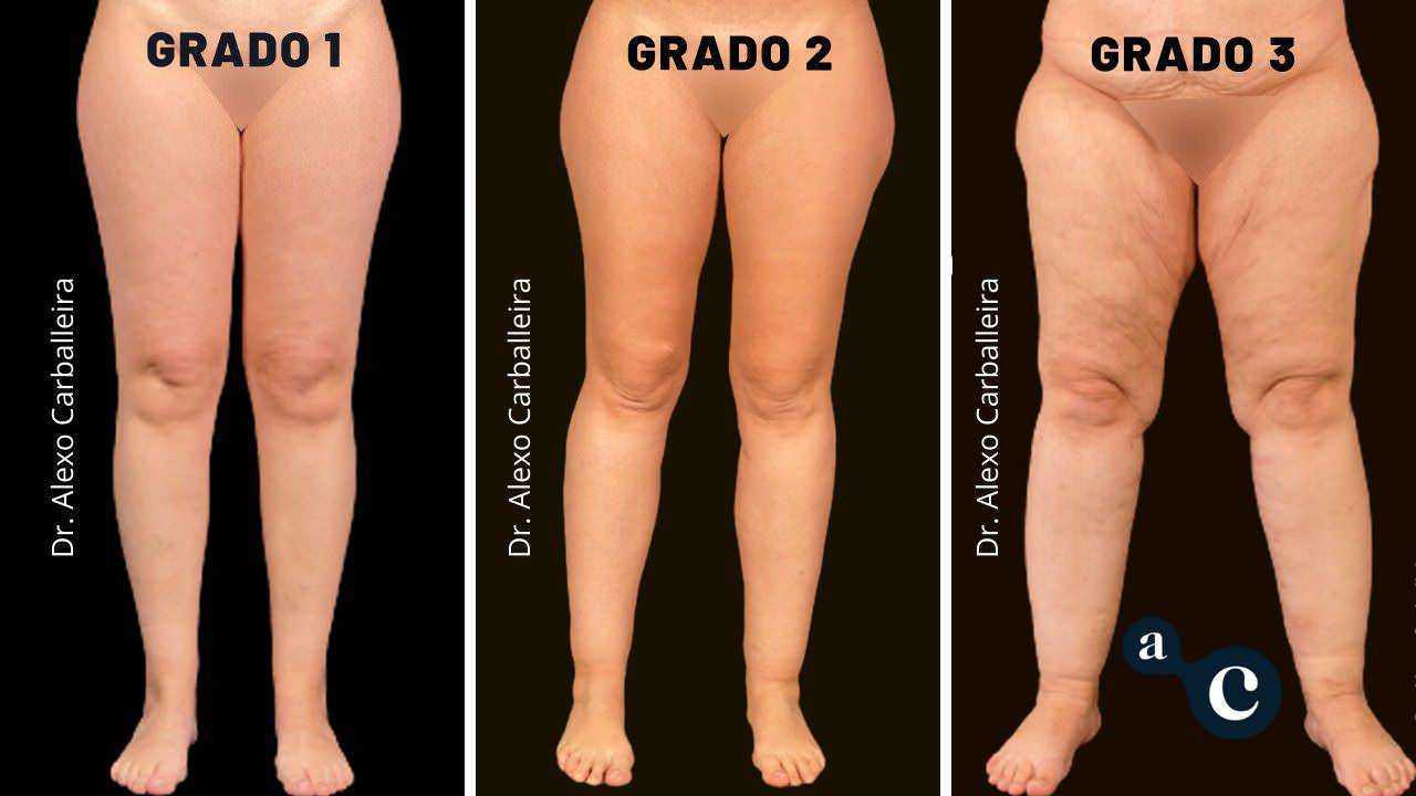 Lipedema sindrome gambe gonfie e trattamenti 5 Lipedema sindrome gambe gonfie e trattamenti (2026). Grado 1, 2 e 3 della cellulite sulle gambe, confronto visivo delle diverse gravità con variazioni di compattezza e invecchiamento della pelle, cura estetica e trattamenti dermatologici.