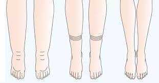 Lipedema sindrome gambe gonfie e trattamenti 4 Piedi con diverse condizioni di salute, evidenziando variazioni delle dita e della pelle per una valutazione medica accurata. Tecniche e consigli per la cura dei piedi e prevenzione delle patologie.