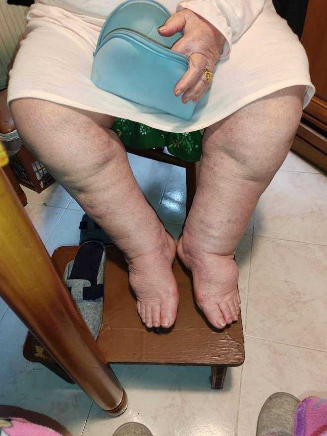Lipedema sindrome gambe gonfie e trattamenti 3 Lipedema sindrome gambe gonfie e trattamenti (2026)