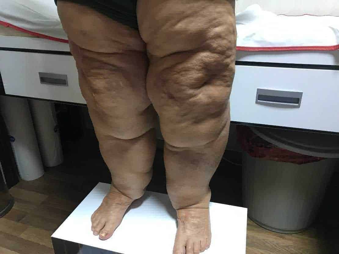 Lipedema sindrome gambe gonfie e trattamenti 2 Lipedema sindrome gambe gonfie e trattamenti (2026). Patologie legate all’accumulo anomalo di tessuto adiposo