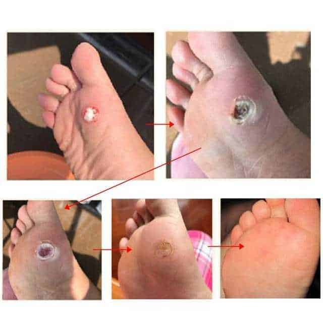 Rimedio naturale per eliminare i calli dei piedi senza dolore.