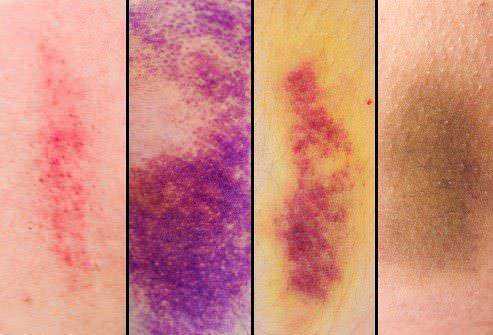 Come eliminare i lividi, 13 rimedi naturali (2026). Palette di colori che richiama le fasi di guarigione di un livido, dal rosso al giallo-verde