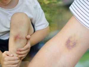 Escoria e lividi su gambe di bambini e adulti a causa di cadute o contusioni in attività all'aperto. Immagine che evidenzia l'importanza di prendersi cura di ferite minori e traumi cutanei.