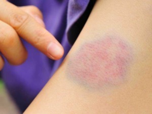 Czv4ptj7g-eczema-pruriginosa-guaina-rossa-sulla-pelle-relazione-alla-irt_-micosi-infezione-infiammazione-eczema-pruriginosa-pelle-infiammata-cure-accurate-dermatologia.