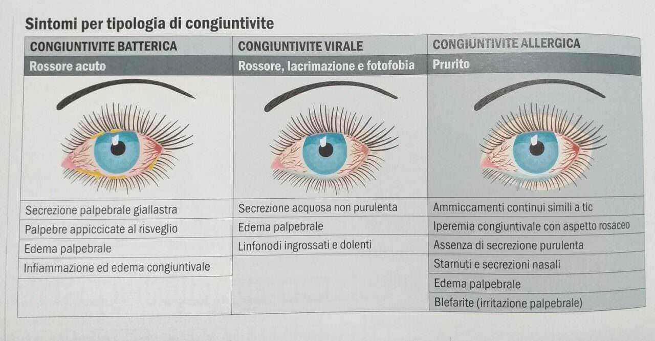 Congiuntivite covid cosa fare? Sintomi e rimedi