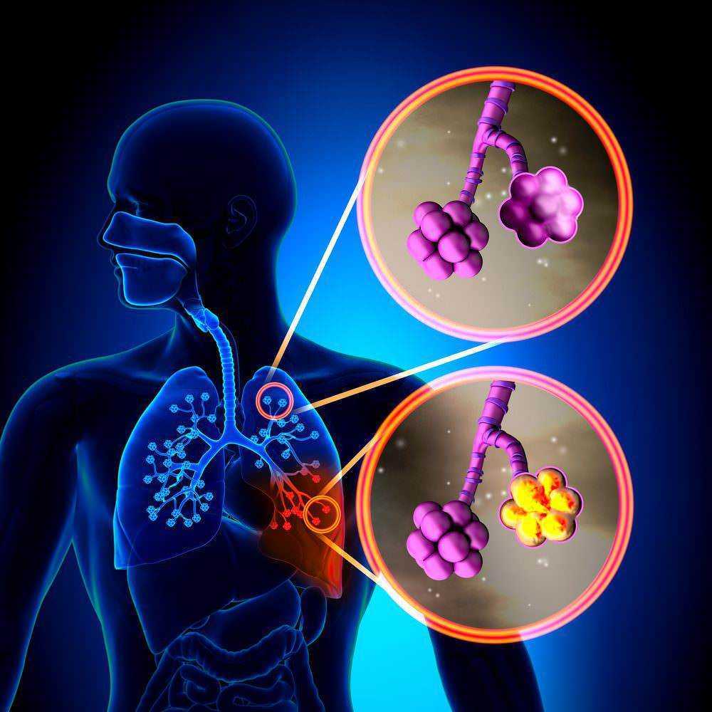 Come pulire i polmoni in 72 ore: salute e anatomia dei polmoni