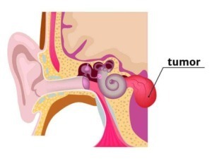 Azienda clinica di un tumore nell'orecchio medio, rappresentazione illustrata delle strutture dell'orecchio con evidenza di tessuto tumorale.