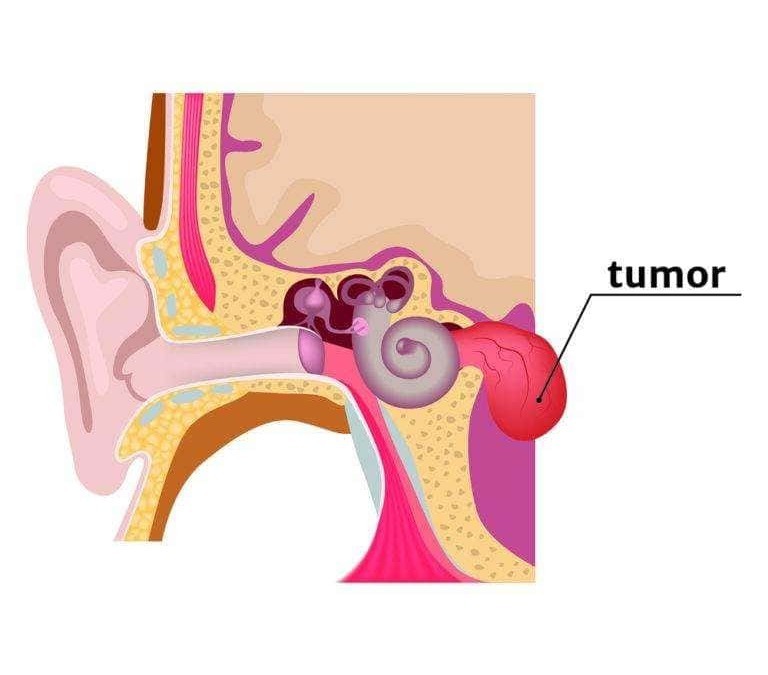 Azienda clinica di un tumore nell'orecchio medio, rappresentazione illustrata delle strutture dell'orecchio con evidenza di tessuto tumorale.