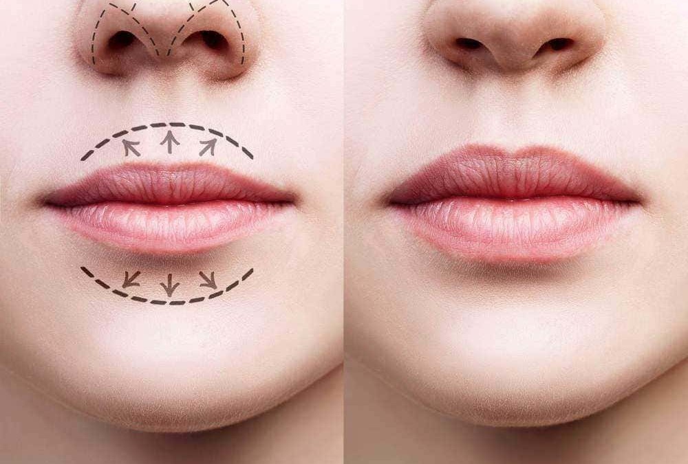Naso e labbra prima e dopo intervento di chirurgia estetica, con linee guida di miglioramento e risultato naturale, focus su rinoplastica e lip filler, immagini di perfezionamento estetico del viso.