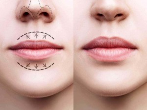 Naso e labbra prima e dopo intervento di chirurgia estetica, con linee guida di miglioramento e risultato naturale, focus su rinoplastica e lip filler, immagini di perfezionamento estetico del viso.