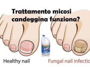 Unghie sane e unghie con infezione da funghi, trattamento antimicotico, rimedi naturali, cura unghie fungus, prevenzione unghie fungine, cerotto antifungo, soluzione per unghie bianche e gialle.
