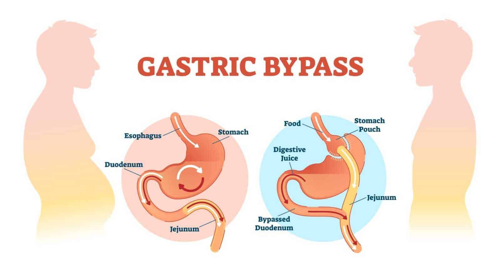 gastric sleeve medical illustration