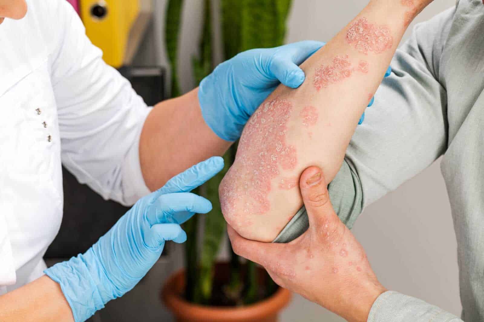 Psoriasi con placche e arrossamento della pelle