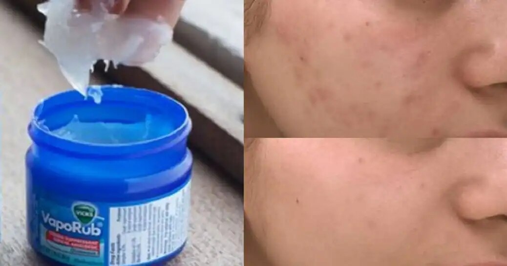 Vicks VapoRub e acne