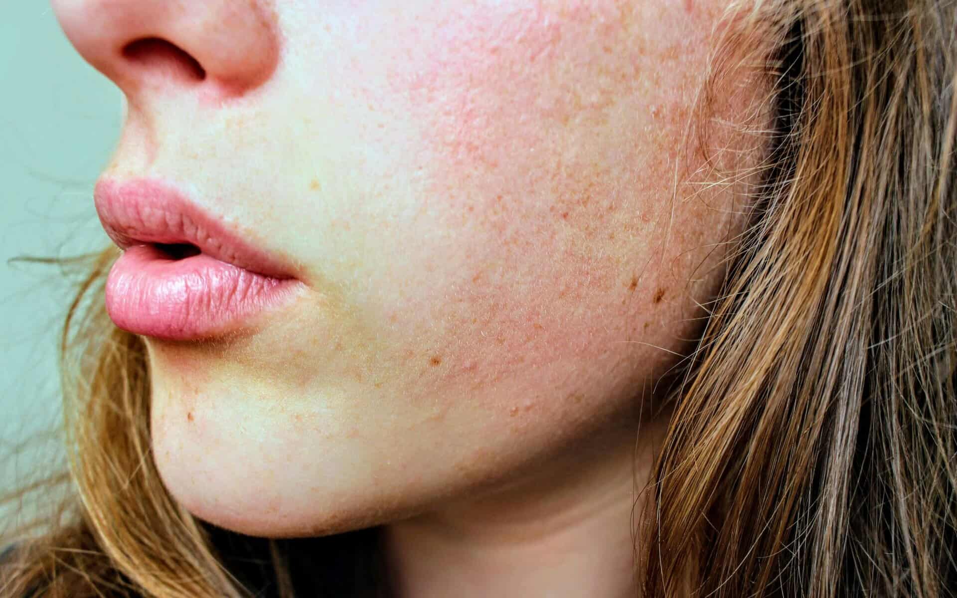 Pelle acneica e punti neri sul viso di una ragazza con capelli castani, evidenziando problemi di pelle e cura del viso.