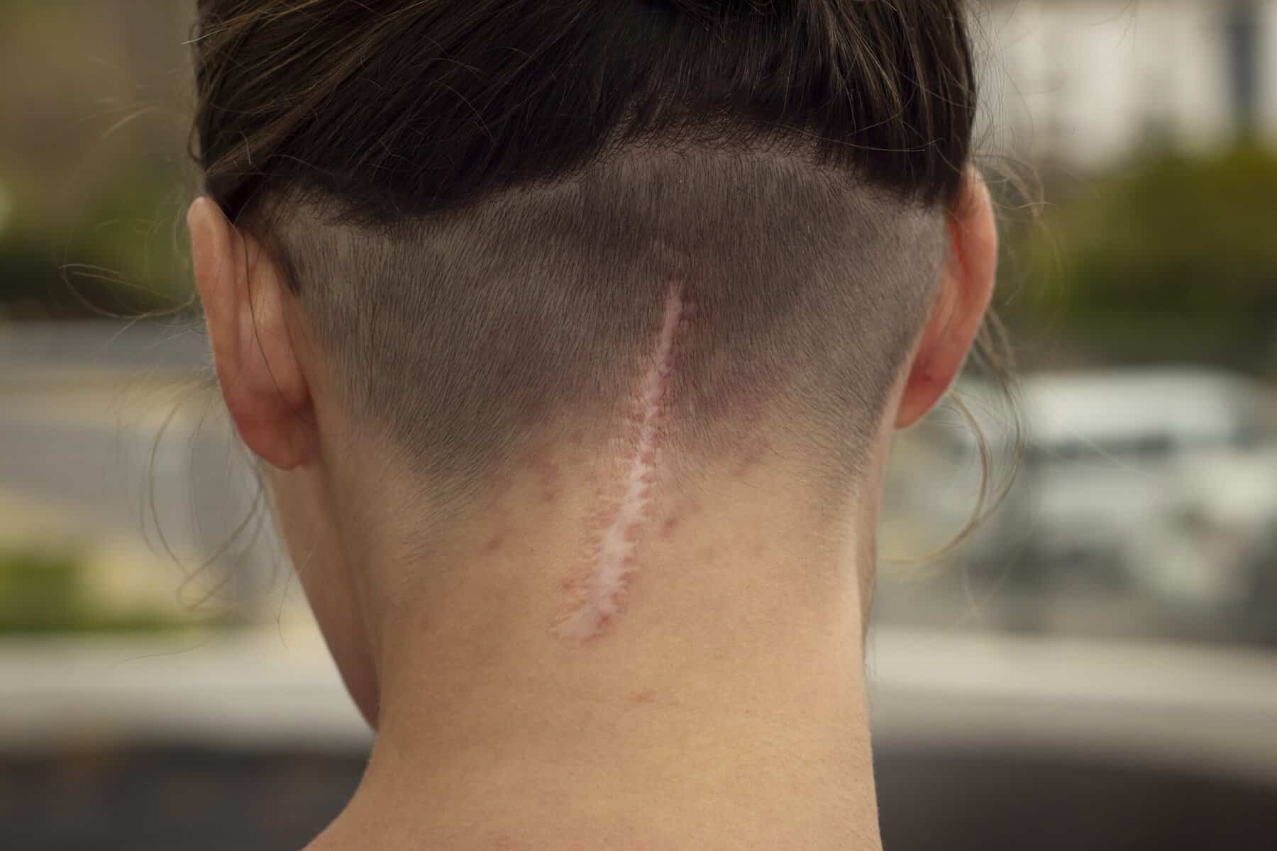 Perché le Cicatrici non si abbronzano e non ricrescono i peli. Immagine di una nuca con una cicatrice evidente a causa di un intervento chirurgico, visibile sulla parte posteriore del collo.