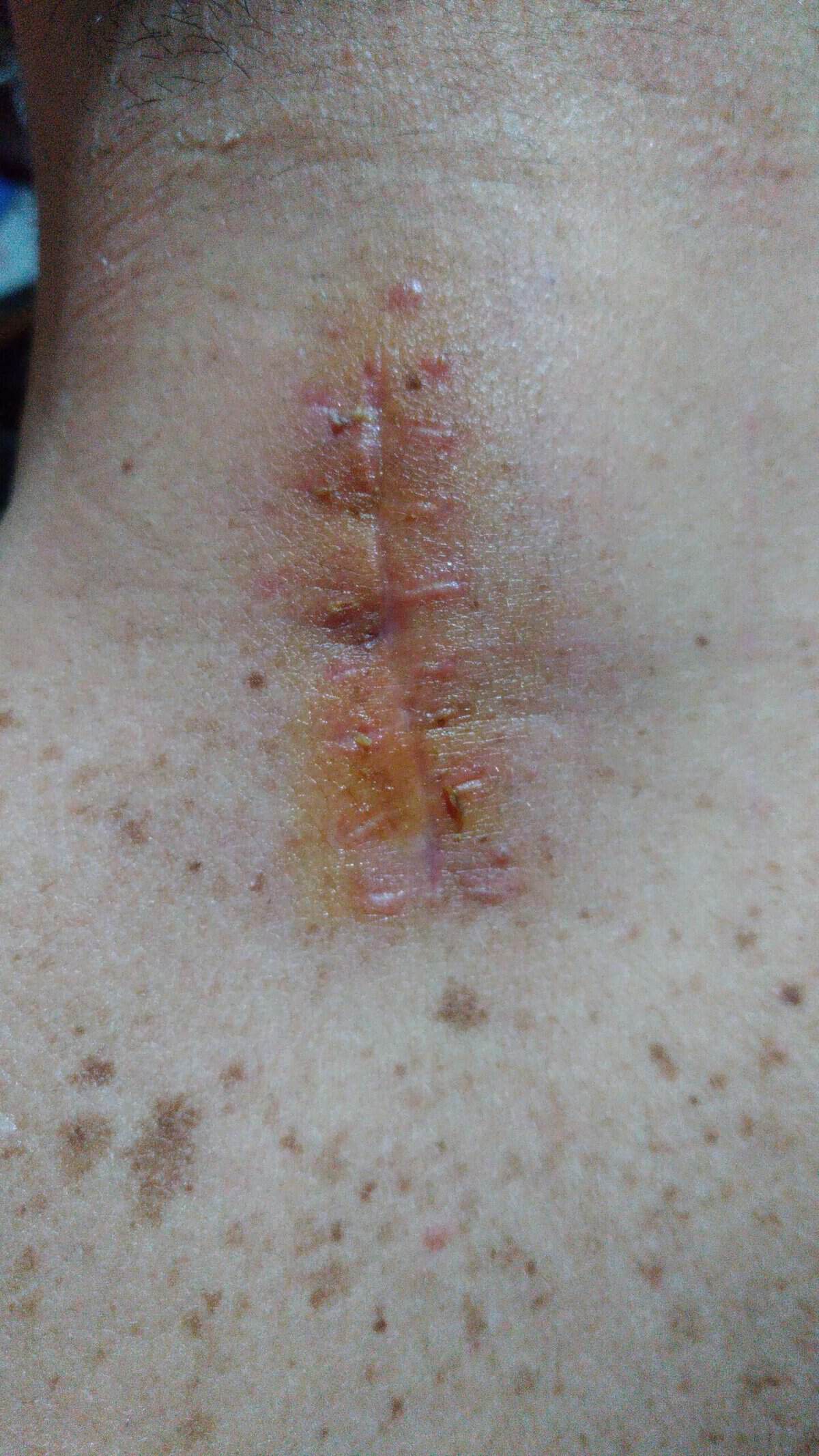 Perché le Cicatrici non si abbronzano e non ricrescono i peli. Immagine di una cicatrice infiammata e cicatrizata sulla pelle, con segni di infiammazione e cicatrici recenti e vecchie.