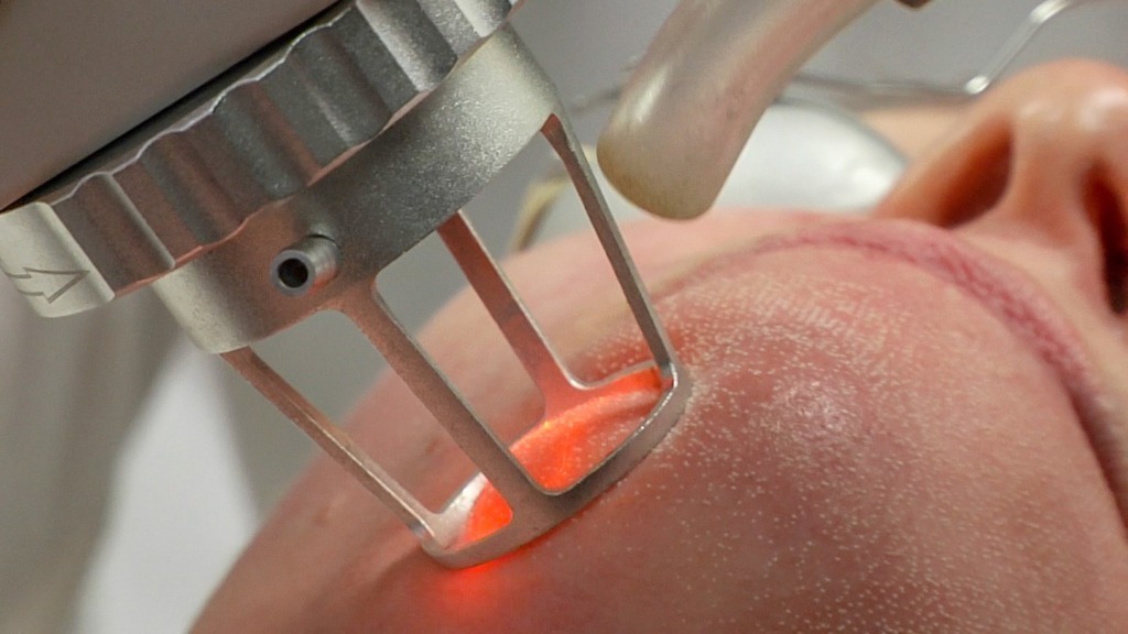 smagliature bianche, trattamento laser della pelle in studio